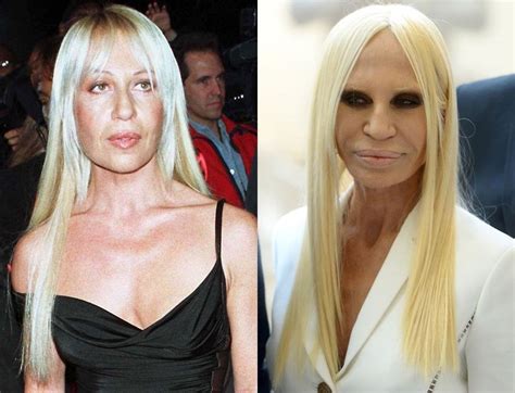 versace plastic surgery before and after|donatella Versace before and after.